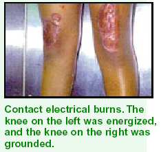 Burns Burns
